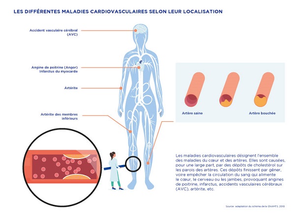Maladie Cardio Vasculaire C Est Quoi NYSNIB maladie-cardio-vasculaire-c-est-quoi-nysnib